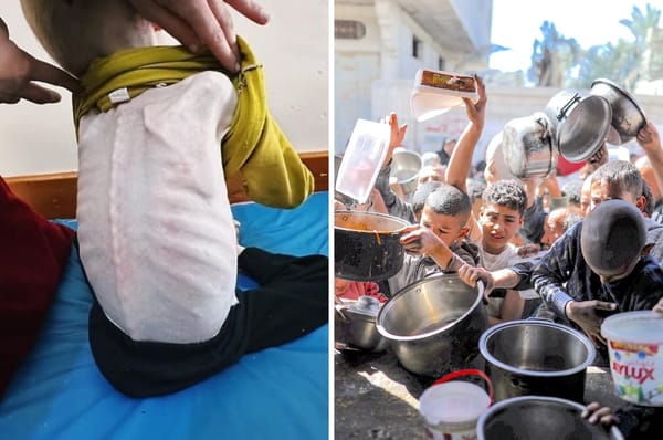 gaza hunger famine israel children malnutrition